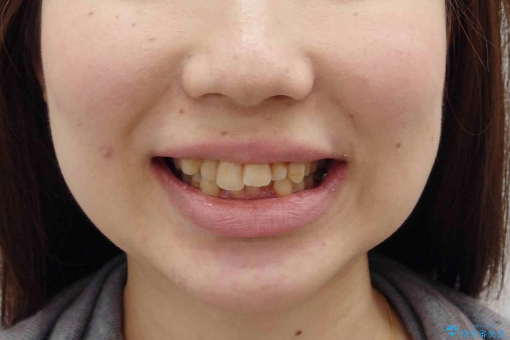 前歯をきれいに　20代女性の治療前（顔貌）