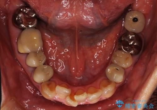 生まれつき歯が黒い　テトラサイクリン歯　40代女性の治療前