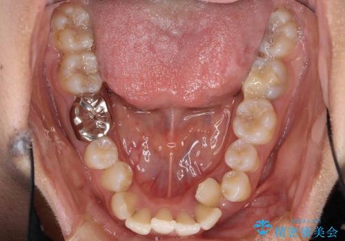 親知らずを移植　残せない奥歯を取り戻す矯正治療の治療前