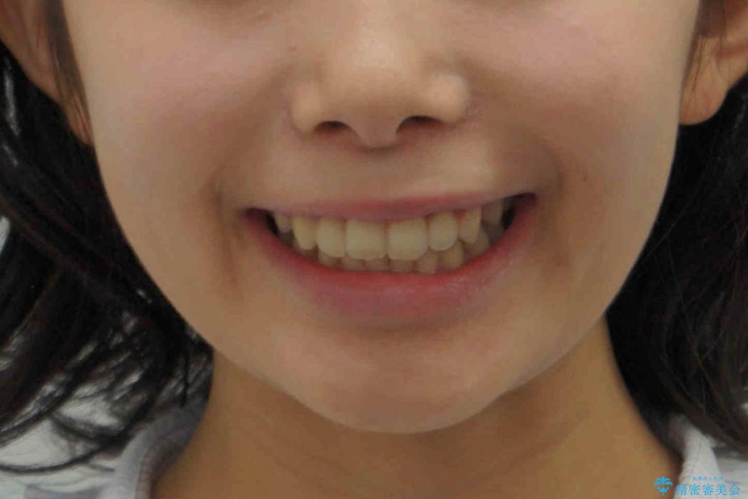 前歯のねじれ　歯を抜かない矯正の治療後（顔貌）