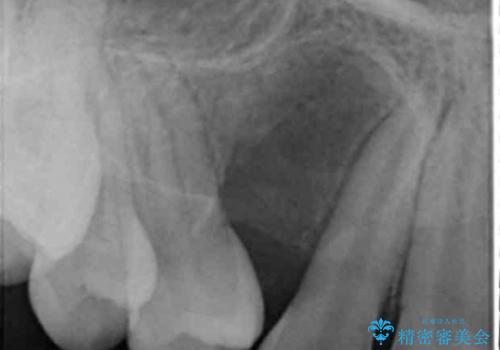 埋まっている犬歯を抜歯して、歯列矯正の治療前