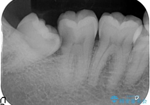 親知らず放置が原因の深い虫歯の治療前