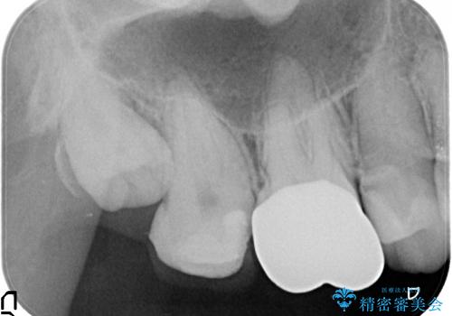 歯髄壊死を生じた右上7番への精密根管治療(イニシャルトリートメント)の治療前