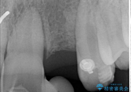 [骨造成を伴う前歯部審美インプラント治療①] インプラント埋入・骨造成・2次手術の治療前