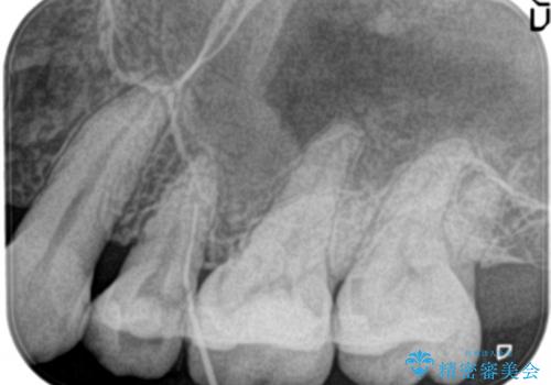 根管治療中の転院:歯ぐきから膿が出てきている左上5番のイニシャルトリートメントの治療前