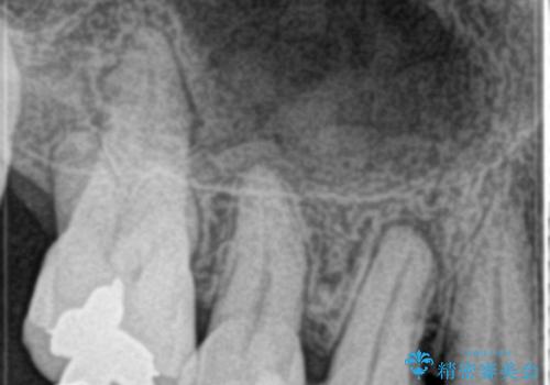 歯の神経の壊死により根尖部に炎症を起こした右上4番への精密根管治療(イニシャルトリートメント)の治療前