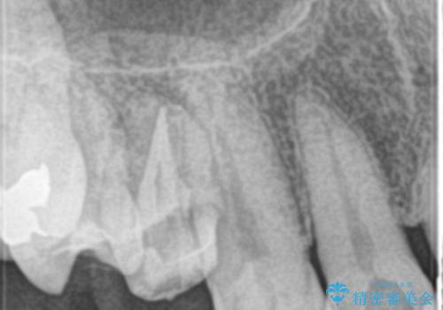 歯の神経の壊死により根尖部に炎症を起こした右上4番への精密根管治療(イニシャルトリートメント)の治療後