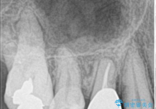 歯の神経の壊死により根尖部に炎症を起こした右上4番への精密根管治療(イニシャルトリートメント)の治療後