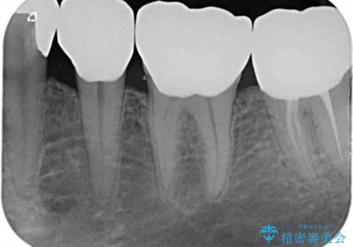 奥歯をセラミックに　銀歯の中の虫歯治療の治療後