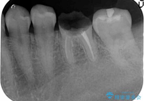 クラウンレングスニング　歯の高径が不足　インビザライン治療の前処置(歯周外科処置)の治療中