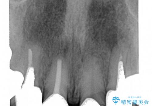 40代女性　歯ぐきのラインをそろえる　部分矯正を用いた前歯の審美修復の治療前