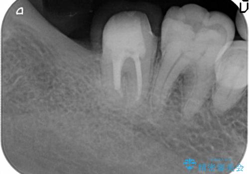 親知らず放置が原因の深い虫歯の治療中