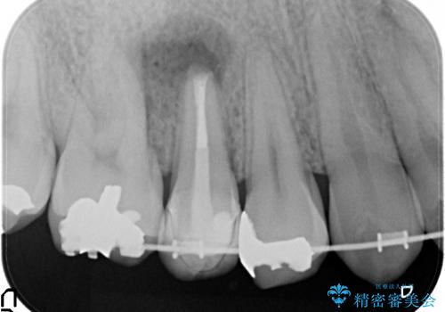 右上5番の歯髄壊死に伴う大きな根尖病変に対する治療その②:矯正治療中の病変の再発へ対する外科的歯内療法(マイクロスコープを用いた歯根端切除術)の治療後