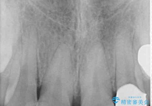 前歯の審美治療　オールセラミックと部分矯正の治療後