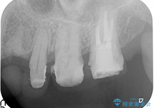 [エムドゲイン]  骨の再生を行った歯周病治療の治療中