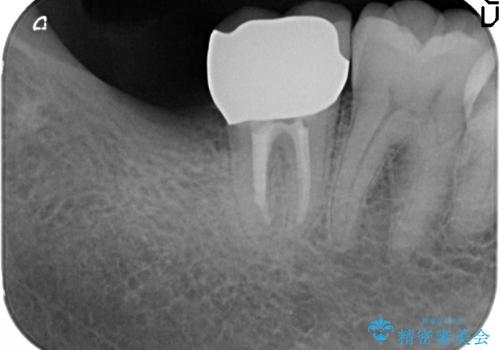 親知らず放置が原因の深い虫歯の治療後