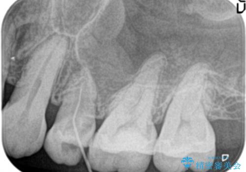 根管治療中の転院:歯ぐきから膿が出てきている左上5番のイニシャルトリートメントの治療前