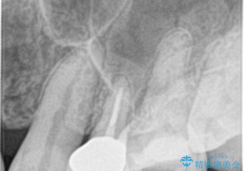 根管治療中の転院:歯ぐきから膿が出てきている左上5番のイニシャルトリートメントの治療後