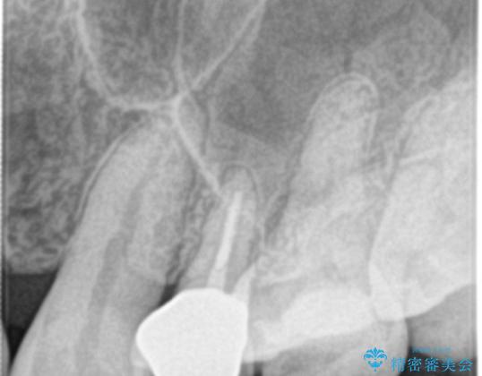 根管治療中の転院:歯ぐきから膿が出てきている左上5番のイニシャルトリートメント