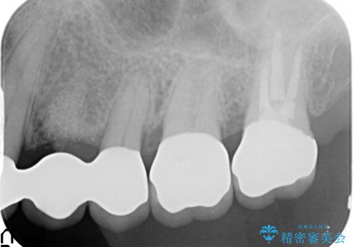 [エムドゲイン]  骨の再生を行った歯周病治療の治療後