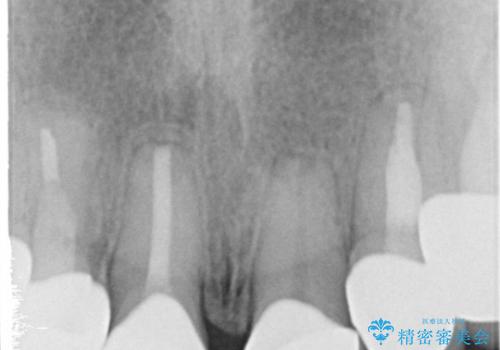 40代女性　歯ぐきのラインをそろえる　部分矯正を用いた前歯の審美修復の治療後