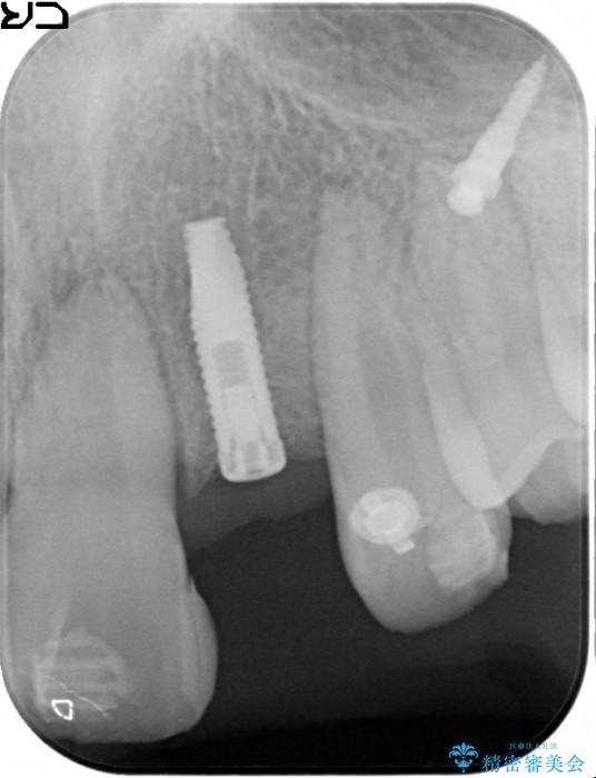 前歯のインプラント_レントゲン写真