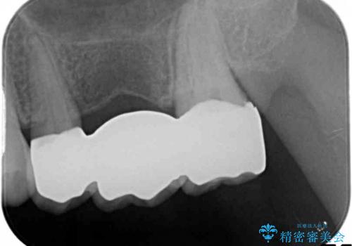 保存不可能な歯のフラップ診断からブリッジ治療の治療後