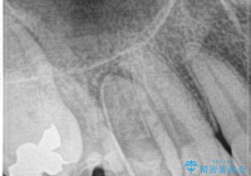 歯の神経の壊死により根尖部に炎症を起こした右上4番への精密根管治療(イニシャルトリートメント)の治療前