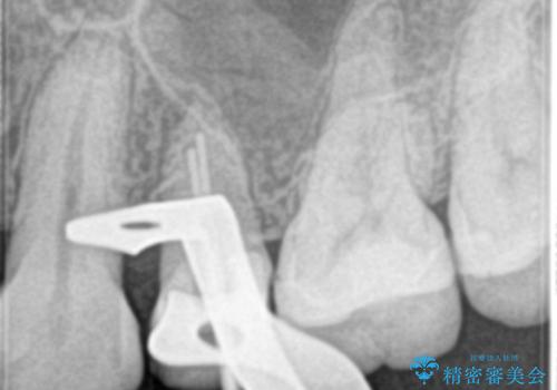 根管治療中の転院:歯ぐきから膿が出てきている左上5番のイニシャルトリートメントの治療中