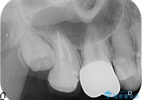 歯髄壊死を生じた右上7番への精密根管治療(イニシャルトリートメント)の治療後