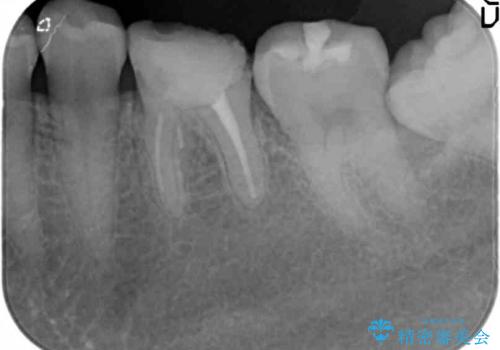 クラウンレングスニング　歯の高径が不足　インビザライン治療の前処置(歯周外科処置)の治療前
