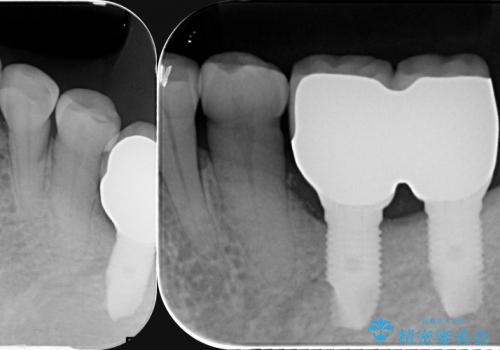 噛み合わせ、前歯を守る 奥歯インプラントの治療中