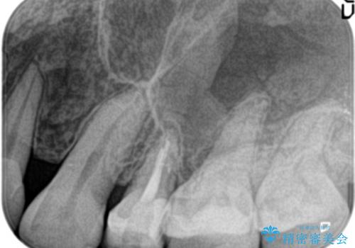 根管治療中の転院:歯ぐきから膿が出てきている左上5番のイニシャルトリートメントの治療後