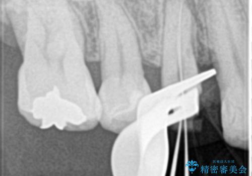 歯の神経の壊死により根尖部に炎症を起こした右上4番への精密根管治療(イニシャルトリートメント)の治療中
