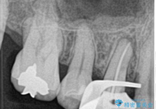 歯の神経の壊死により根尖部に炎症を起こした右上4番への精密根管治療(イニシャルトリートメント)の治療中