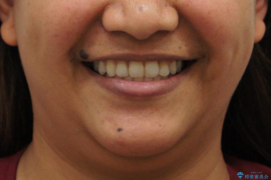 親知らずを移植　残せない奥歯を取り戻す矯正治療の治療後（顔貌）