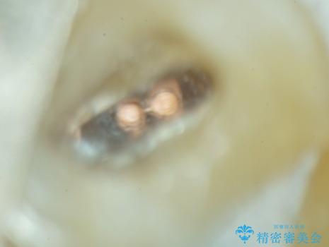 根管治療中の転院:歯ぐきから膿が出てきている左上5番のイニシャルトリートメントの治療中