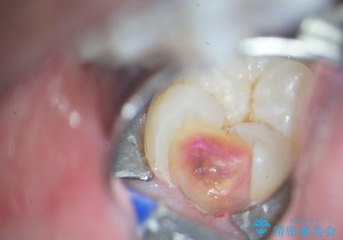 親知らず放置が原因の深い虫歯の治療前