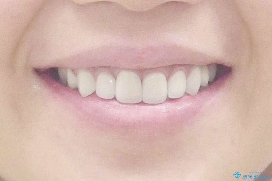 生まれつき歯が黒い　テトラサイクリン歯　40代女性の治療後（顔貌）