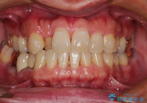 前歯の歯並びの改善　クリアブラケットによる矯正治療　
