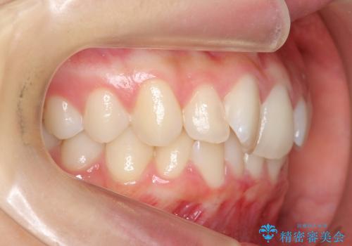 前歯のねじれ　歯を抜かない矯正の治療前