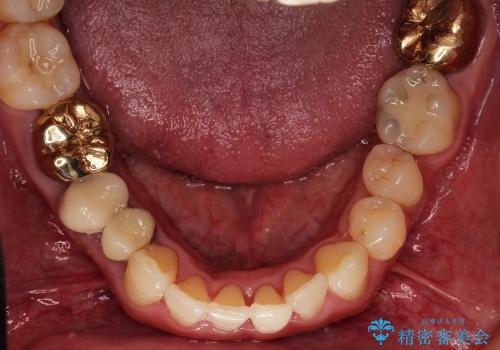 前歯の歯並びの改善　クリアブラケットによる矯正治療　の治療前