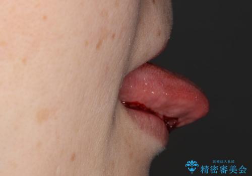 舌小帯強直症　レーザーで痛みのない治療　大人も効果がありますの治療中