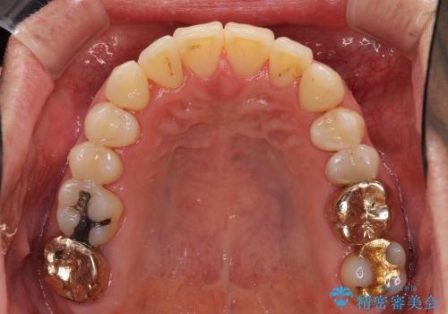 前歯の歯並びの改善　クリアブラケットによる矯正治療　の治療後