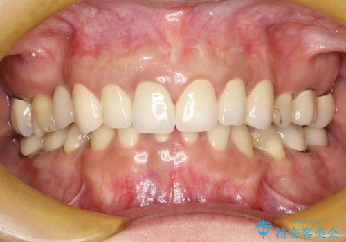 40代女性　歯ぐきのラインをそろえる　部分矯正を用いた前歯の審美修復の治療後