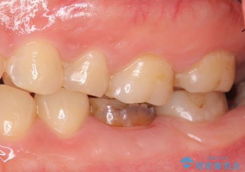 クラウンレングスニング　歯の高径が不足　インビザライン治療の前処置(歯周外科処置)の治療前