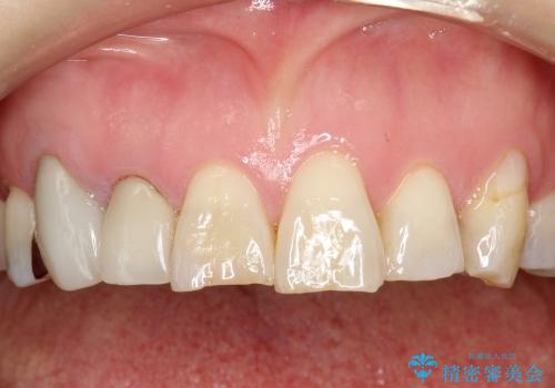 40代女性　前歯の審美修復　土台や根管治療には介入せずの治療前