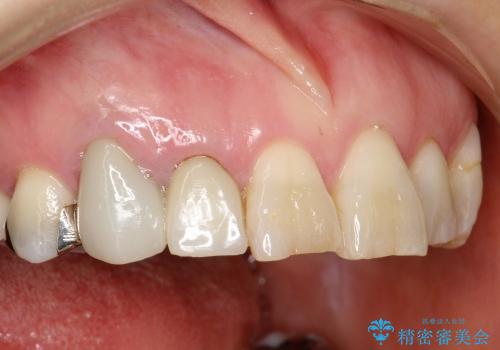 40代女性　前歯の審美修復　土台や根管治療には介入せずの治療前