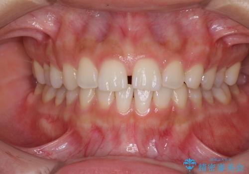 インビザラインとホワイトニング　白い歯ときれいな歯並び