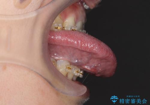 舌小帯強直症　レーザーで痛みのない治療　大人も効果がありますの治療後